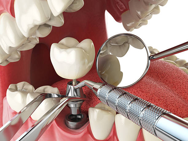 Best Broken or Cracked Tooth Emergency Dentist in Seguin, TX